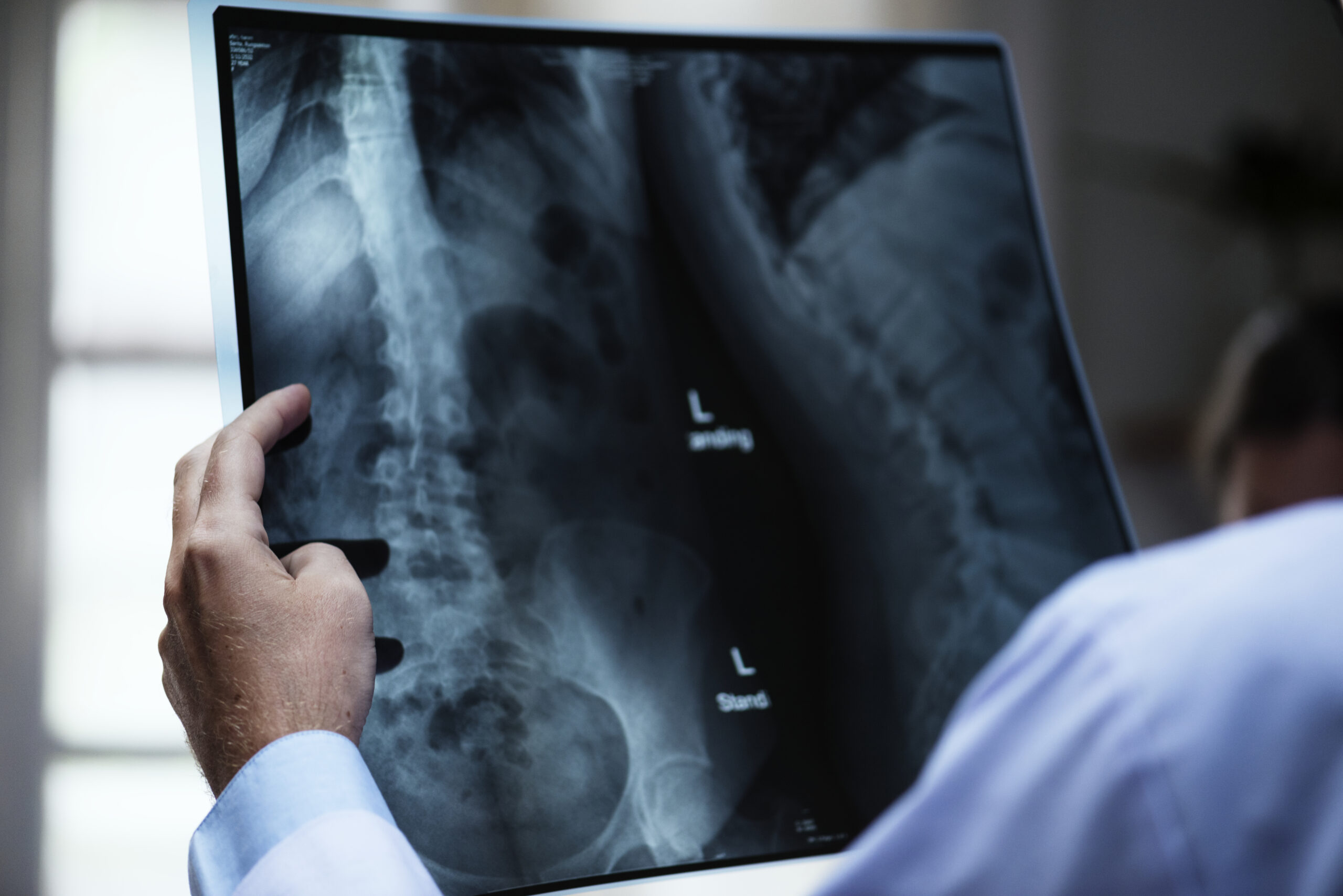 Médico a observar uma radiografia da coluna lombar e da bacia, feita em pé